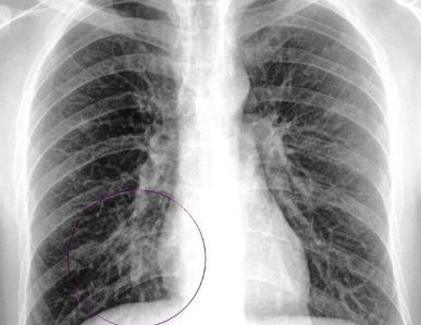pnevmonia